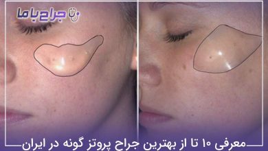 بهترین جراح پروتز گونه در ایران