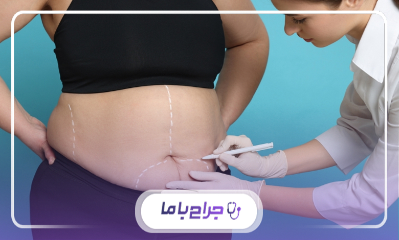 راهنمای انتخاب بهترین جراح اسلیو معده در شیراز