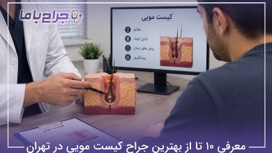 بهترین جراح کیست مویی در تهران