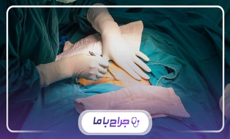مراقبتهای طلایی پس از جراحی فتق