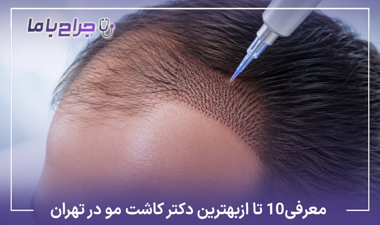معرفی 10 تا از بهترین دکتر کاشت مو در تهران【سال1405】⚡
