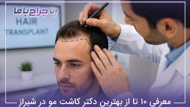 بهترین دکتر کاشت مو در شیراز
