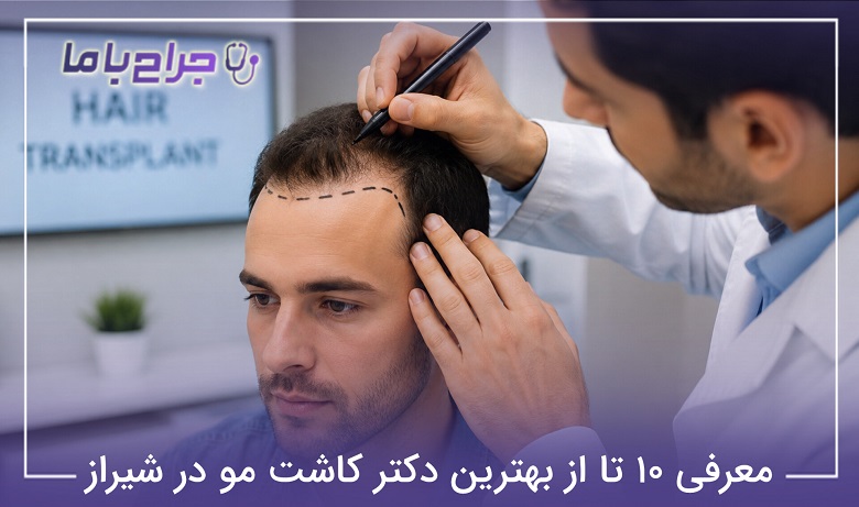 بهترین دکتر کاشت مو در شیراز