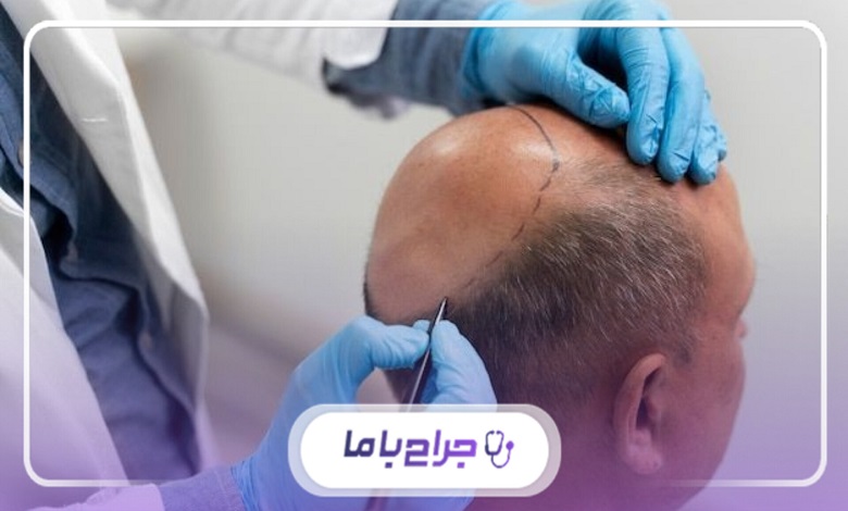 روشهای کاشت مو در شیراز: کدام روش مناسب شماست؟
