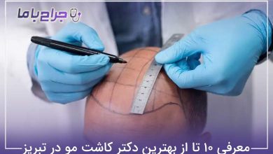 بهترین دکتر کاشت مو در تبریز