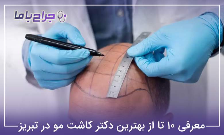 بهترین دکتر کاشت مو در تبریز