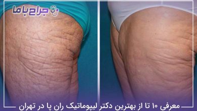 بهترین دکتر لیپوماتیک ران پا در تهران