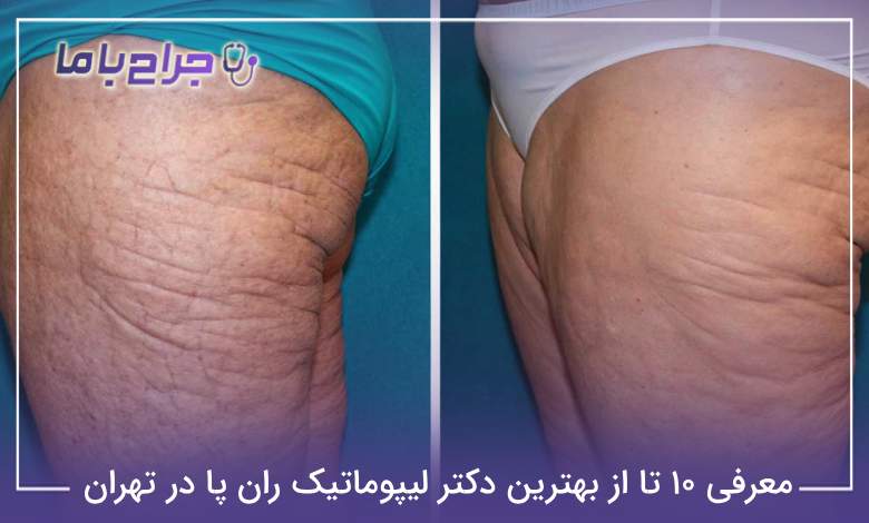 بهترین دکتر لیپوماتیک ران پا در تهران