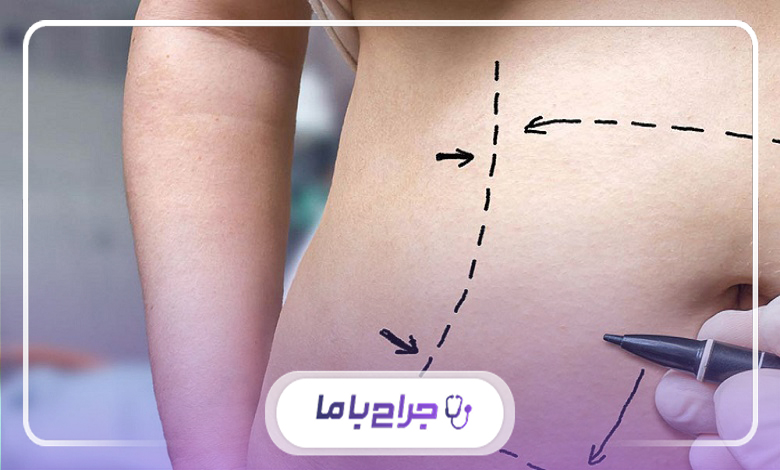 ویژگیهای بهترین جراح ابدومینوپلاستی کرج