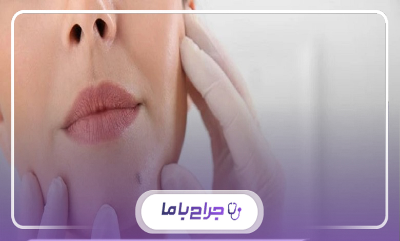 مزایای مراجعه به بهترین مرکز خال برداری در اندیشه