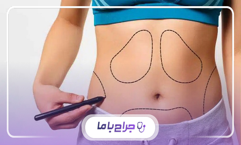 نحوه انتخاب جراح ابدومینوپلاستی خوب در شیراز چگونه است؟