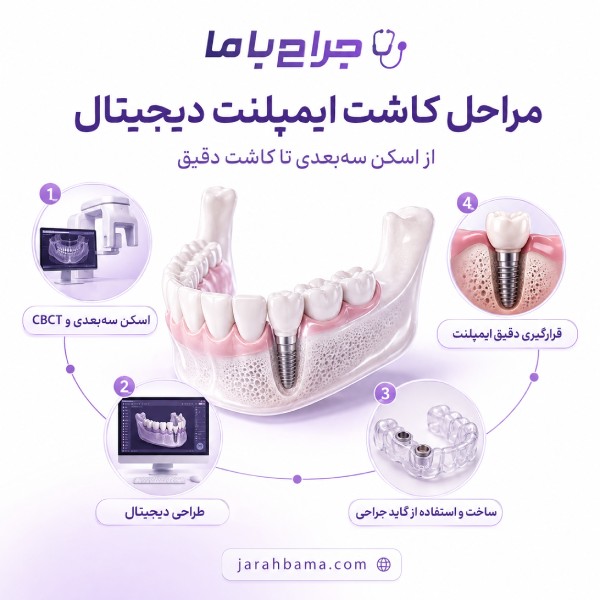 ایمپلنت دیجیتال چیست و چگونه انجام میشود؟
