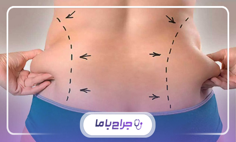 نکات مهم قبل از انتخاب بهترین جراح لیپوماتیک در کرج