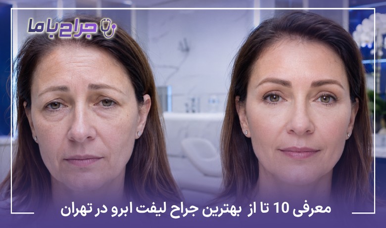 معرفی10 تا از بهترین جراح لیفت ابرو در تهران【آپدیت1405】❤️