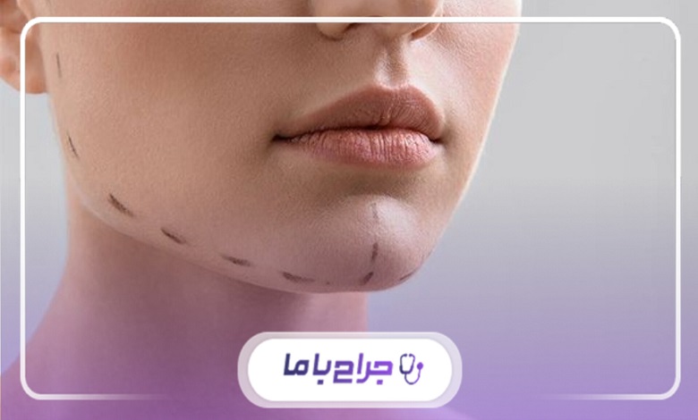 بهترین جراح بوکال فت در تهران چه کسی است؟