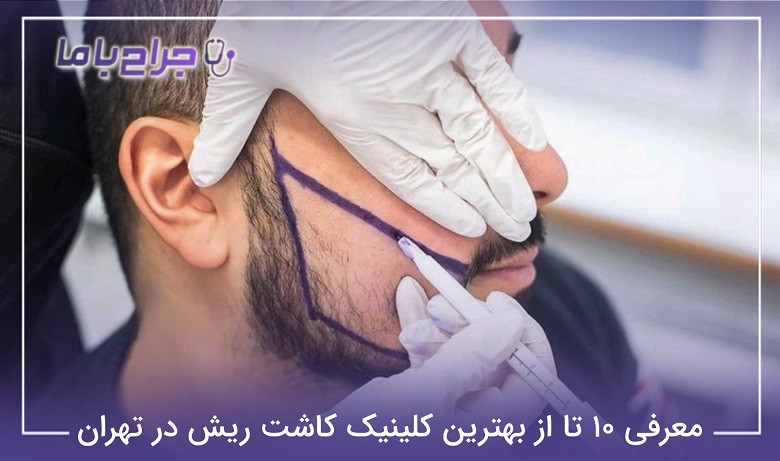 بهترین کلینیک کاشت ریش در تهران