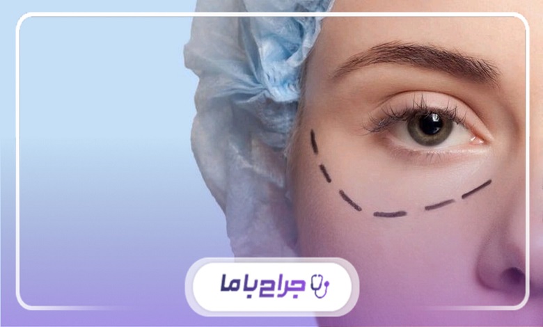 چگونه بهترین جراح بلفاروپلاستی در اصفهان را انتخاب کنیم؟