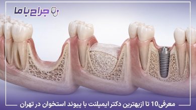 معرفی۱۰ تا از بهترین دکتر ایمپلنت با پیوند استخوان در تهران【آپدیت1405】⚡