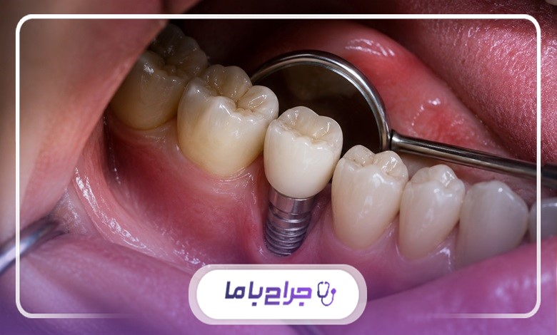 مراقبتهای بعد از کاشت ایمپلنت