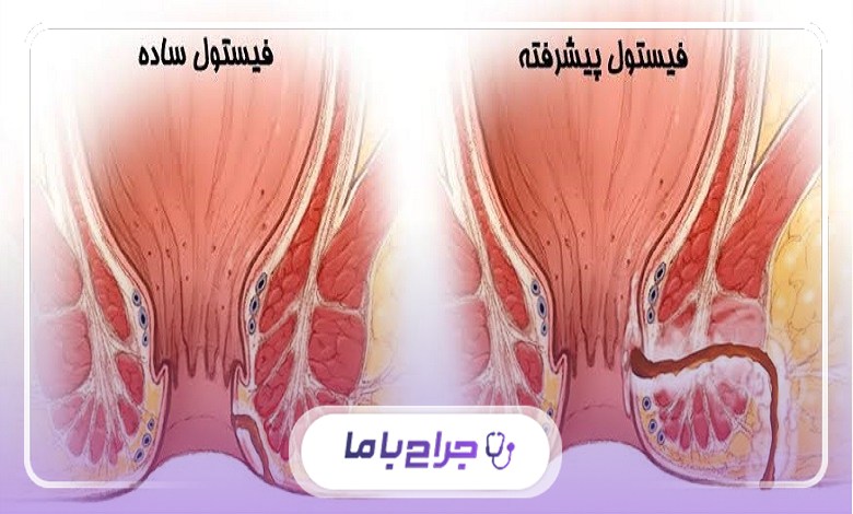 استانداردهای یک جراحی موفق برای درمان فیستول در تهران