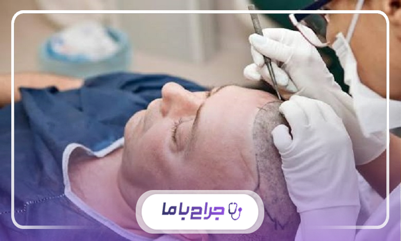 چرا انتخاب بهترین جراح کاشت مو در مشهد اهمیت دارد؟