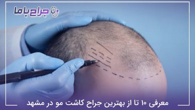 معرفی 10 تا از بهترین جراح کاشت مو در مشهد【سال1405】✅