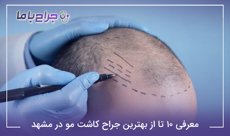 معرفی 10 تا از بهترین جراح کاشت مو در مشهد【سال1405】✅