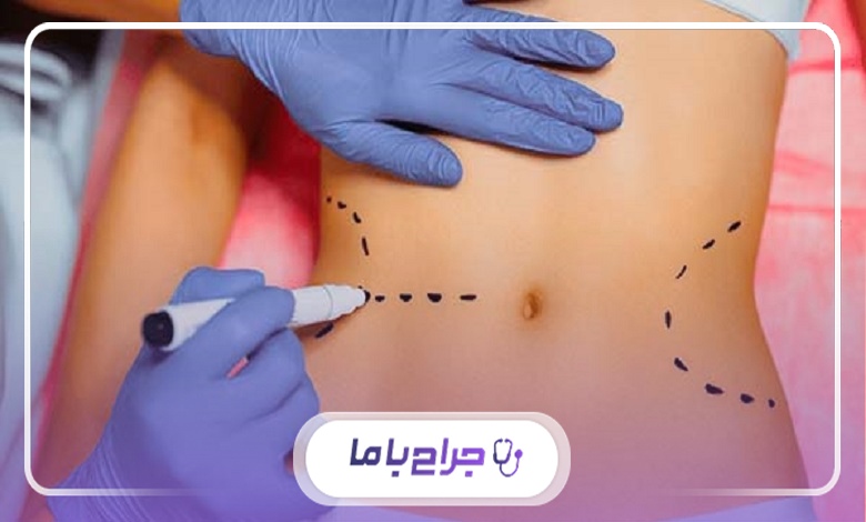 مراحل انجام عمل پیکرتراشی توسط بهترین جراح لاغری در اصفهان