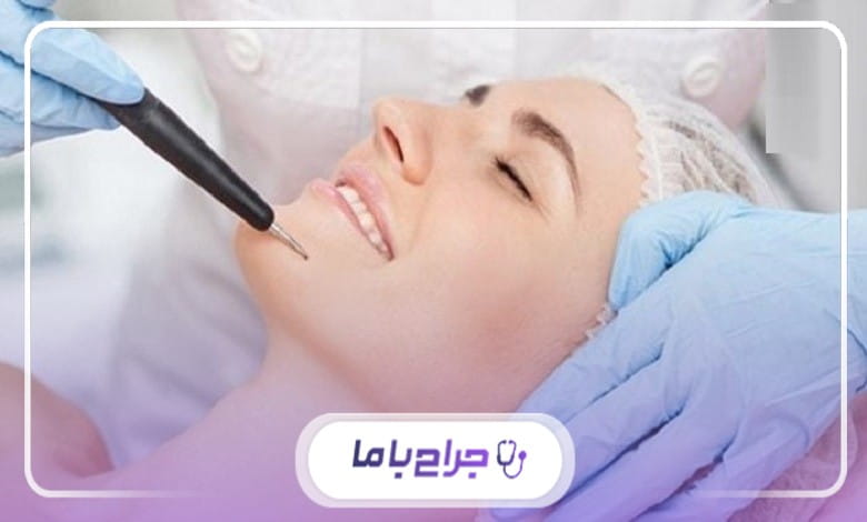 مراحل برداشتن خال با لیزر در مرکز خال برداری